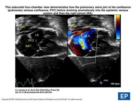 This subcostal four-chamber view demonstrates how the pulmonary veins join at the confluence (pulmonary venous confluence, PVC) before draining anomalously.