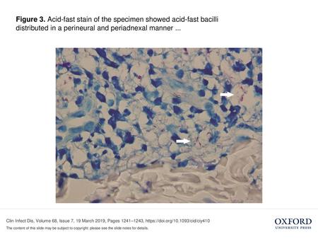 Figure 3. Acid-fast stain of the specimen showed acid-fast bacilli distributed in a perineural and periadnexal manner ... Figure 3. Acid-fast stain of.