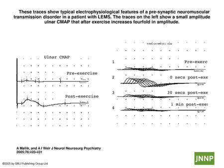  These traces show typical electrophysiological features of a pre-synaptic neuromuscular transmission disorder in a patient with LEMS. The traces on the.