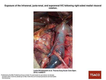 Exposure of the infrarenal, juxta-renal, and suprarenal IVC following right-sided medial visceral rotation. Exposure of the infrarenal, juxta-renal, and.