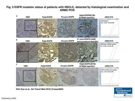 Fig. 5 EGFR mutation status of patients with NSCLC, detected by histological examination and ARMS PCR. EGFR mutation status of patients with NSCLC, detected.