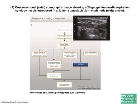 (A) Cross-sectional (axial) sonographic image showing a 21-gauge fine-needle aspiration cytology needle introduced in a 12 mm supraclavicular lymph node.