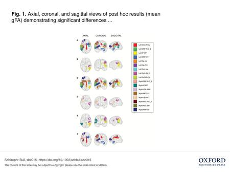 Fig. 1. Axial, coronal, and sagittal views of post hoc results (mean gFA) demonstrating significant differences ... Fig. 1. Axial, coronal, and sagittal.