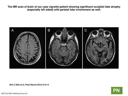 The MR scan of brain of our case vignette patient showing significant occipital lobe atrophy (especially left sided) with parietal lobe involvement as.