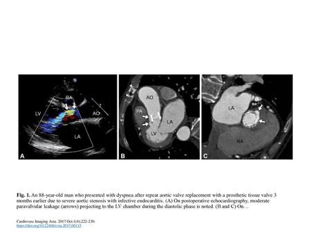 Fig. 1. An 88-year-old man who presented with dyspnea after repeat aortic valve replacement with a prosthetic tissue valve 3 months earlier due to severe.