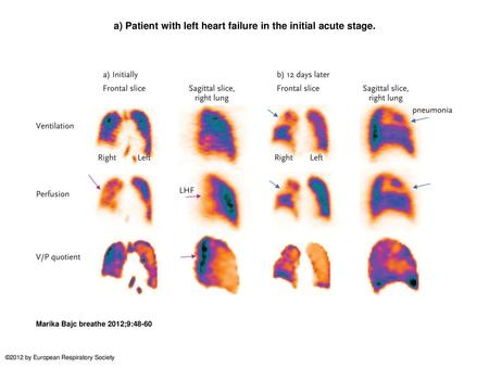 a) Patient with left heart failure in the initial acute stage.