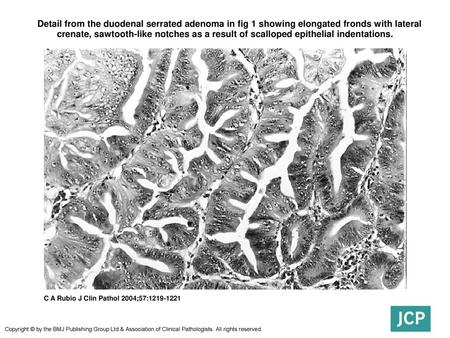  Detail from the duodenal serrated adenoma in fig 1 showing elongated fronds with lateral crenate, sawtooth-like notches as a result of scalloped epithelial.