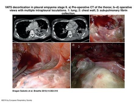 VATS decortication in pleural empyema stage II