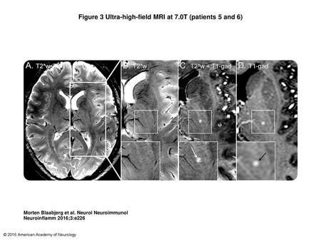 Figure 3 Ultra-high-field MRI at 7.0T (patients 5 and 6)‏