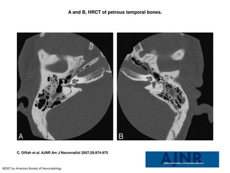 A and B, HRCT of petrous temporal bones.