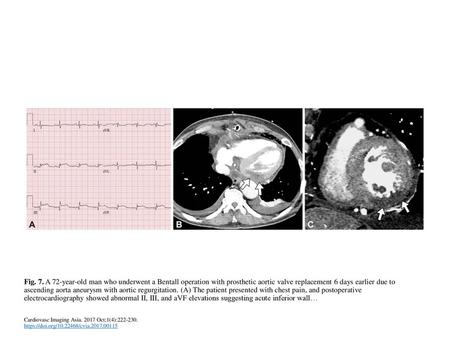 Fig. 7. A 72-year-old man who underwent a Bentall operation with prosthetic aortic valve replacement 6 days earlier due to ascending aorta aneurysm with.