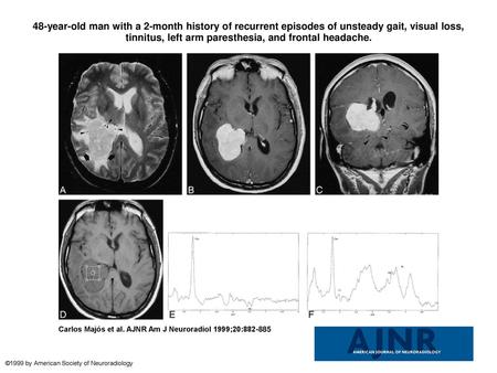 48-year-old man with a 2-month history of recurrent episodes of unsteady gait, visual loss, tinnitus, left arm paresthesia, and frontal headache. 48-year-old.