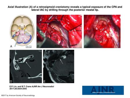 Axial illustration (A) of a retrosigmoid craniotomy reveals a typical exposure of the CPA and lateral IAC by drilling through the posterior meatal lip.