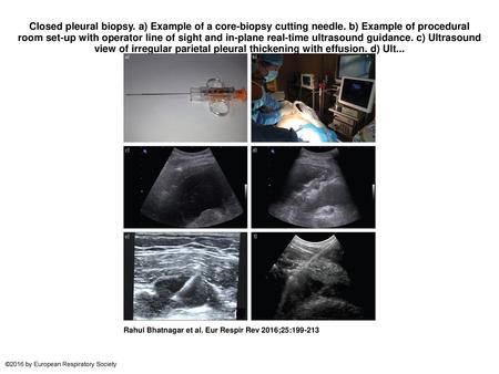 Closed pleural biopsy. a) Example of a core-biopsy cutting needle