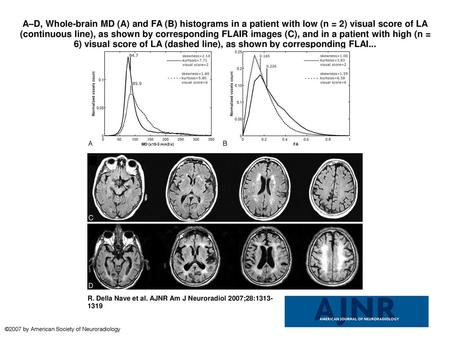 A–D, Whole-brain MD (A) and FA (B) histograms in a patient with low (n = 2) visual score of LA (continuous line), as shown by corresponding FLAIR images.