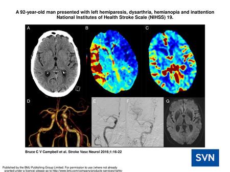 A 92-year-old man presented with left hemiparesis, dysarthria, hemianopia and inattention National Institutes of Health Stroke Scale (NIHSS) 19. A 92-year-old.