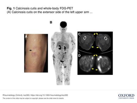 (A) Calcinosis cutis on the extensor side of the left upper arm ...