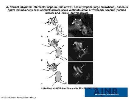 A, Normal labyrinth: interscalar septum (thin arrow), scala tympani (large arrowhead), osseous spiral lamina/cochlear duct (thick arrow), scala vestibuli.
