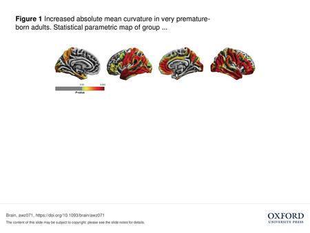 Figure 1 Increased absolute mean curvature in very premature-born adults. Statistical parametric map of group ... Figure 1 Increased absolute mean curvature.