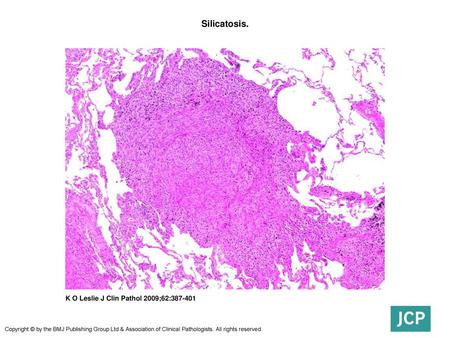 Silicatosis. Silicatosis. Similar to sarcoidosis in distribution, the nodules of silicate disease can be distinguished by the common occurrence of dark.