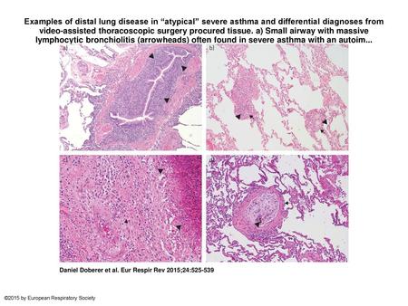 Examples of distal lung disease in “atypical” severe asthma and differential diagnoses from video-assisted thoracoscopic surgery procured tissue. a) Small.