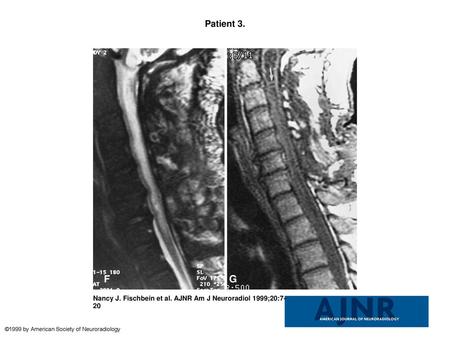 Patient 3. Patient 3. A, Sagittal T2-weighted image (4000/108eff /4) obtained when the patient had no symptoms referable to the spinal cord shows a mild.