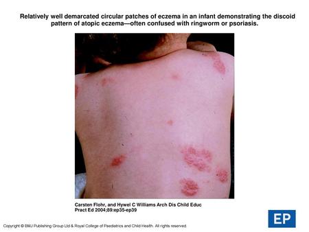  Relatively well demarcated circular patches of eczema in an infant demonstrating the discoid pattern of atopic eczema—often confused with ringworm or.