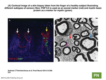 (A) Confocal image of a skin biopsy taken from the finger of a healthy subject illustrating different subtypes of sensory fibre: PGP 9.5 is used as an.