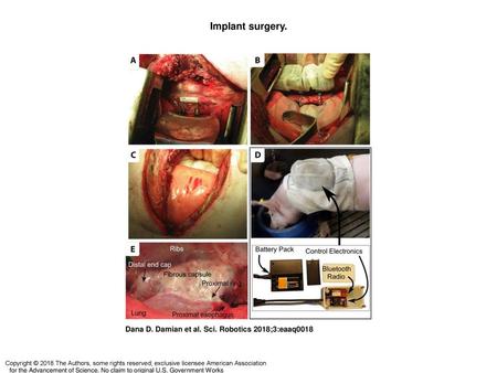 Implant surgery. Implant surgery. (A) Suturing of rings to the esophagus. (B) A silicone sheet is inserted behind the esophagus, and the implant is connected.