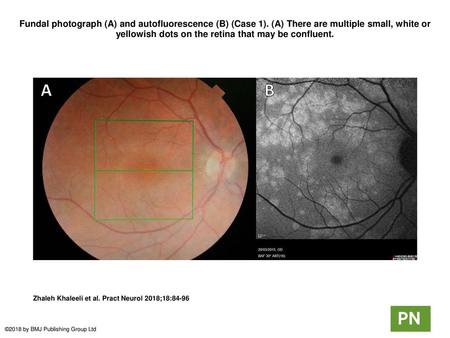 Fundal photograph (A) and autofluorescence (B) (Case 1)