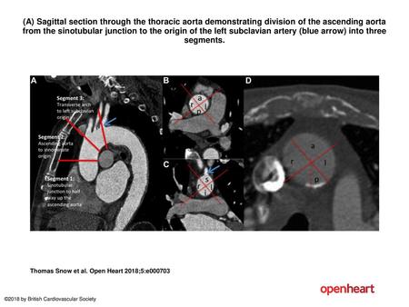 (A) Sagittal section through the thoracic aorta demonstrating division of the ascending aorta from the sinotubular junction to the origin of the left subclavian.