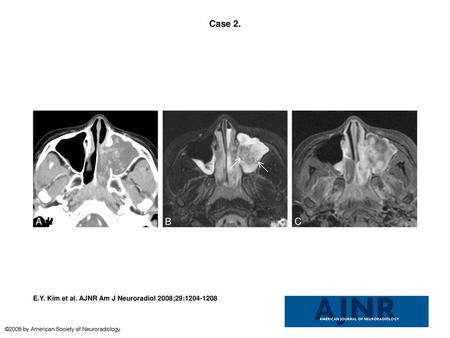 Case 2. Case 2. Organized hematoma arising from antrochoanal polyp in a 12-year-old girl. A, Contrast-enhanced axial CT scan shows marked irregular nodular.