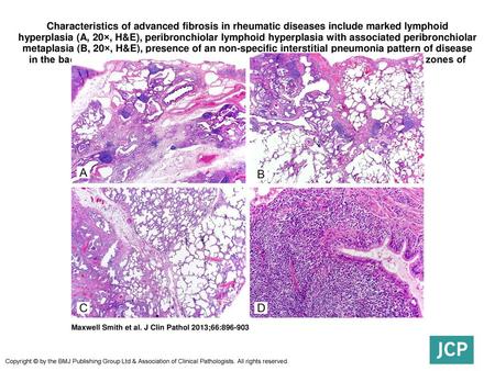 Characteristics of advanced fibrosis in rheumatic diseases include marked lymphoid hyperplasia (A, 20×, H&E), peribronchiolar lymphoid hyperplasia with.