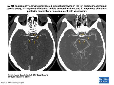 (A) CT angiography showing unexpected luminal narrowing in the left supraclinoid internal carotid artery, M1 segment of bilateral middle cerebral arteries,