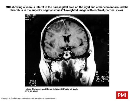 MRI showing a venous infarct in the parasagittal area on the right and enhancement around the thrombus in the superior sagittal sinus (T1-weighted image.