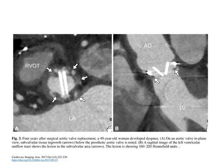 Fig. 3. Four years after surgical aortic valve replacement, a 49-year-old woman developed dyspnea. (A) On an aortic valve in-plane view, subvalvular tissue.