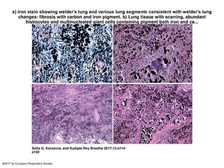 A) Iron stain showing welder’s lung and various lung segments consistent with welder’s lung changes: fibrosis with carbon and iron pigment. b) Lung tissue.