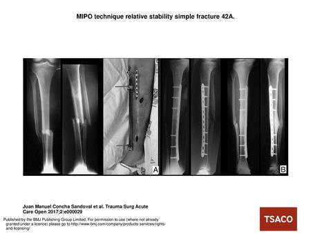 MIPO technique relative stability simple fracture 42A.