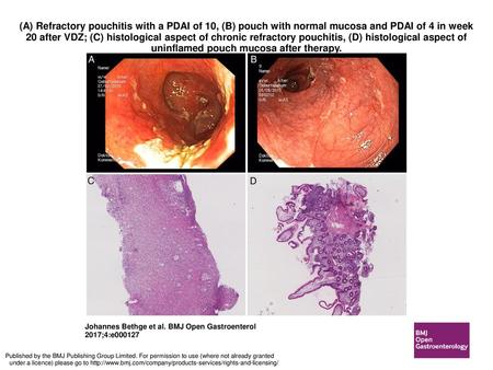 (A) Refractory pouchitis with a PDAI of 10, (B) pouch with normal mucosa and PDAI of 4 in week 20 after VDZ; (C) histological aspect of chronic refractory.