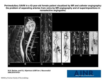 Perimedullary SAVM in a 43-year-old female patient visualized by MR and catheter angiography: the problem of separating arteries from veins by MR angiography.