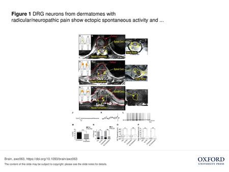 Figure 1 DRG neurons from dermatomes with radicular/neuropathic pain show ectopic spontaneous activity and ... Figure 1 DRG neurons from dermatomes with.