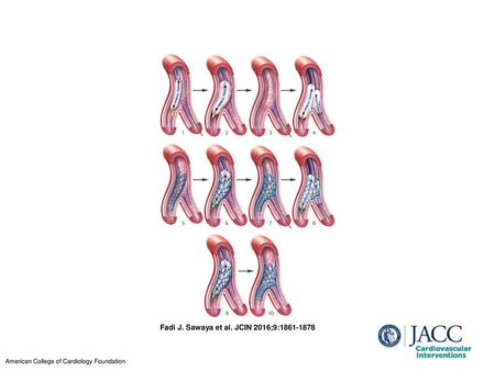 Fadi J. Sawaya et al. JCIN 2016;9: