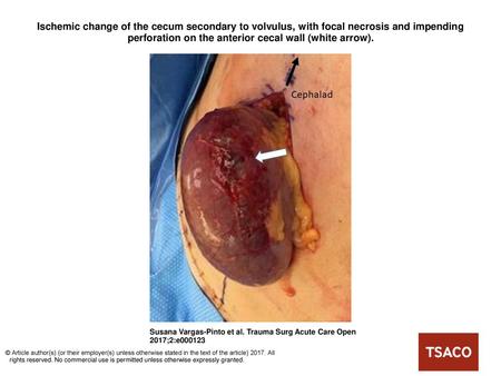 Ischemic change of the cecum secondary to volvulus, with focal necrosis and impending perforation on the anterior cecal wall (white arrow). Ischemic change.