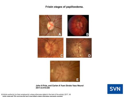 Frisén stages of papilloedema.