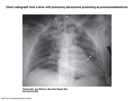 Chest radiograph from a diver with pulmonary barotrauma presenting as pneumomediastinum. Chest radiograph from a diver with pulmonary barotrauma presenting.