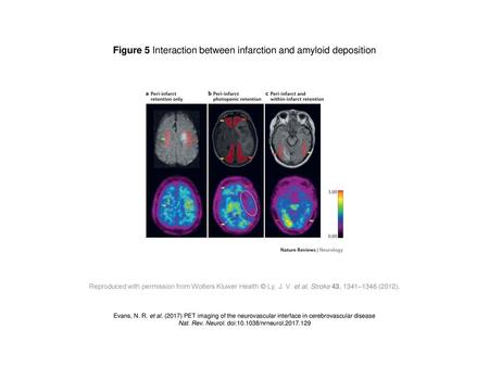 Figure 5 Interaction between infarction and amyloid deposition