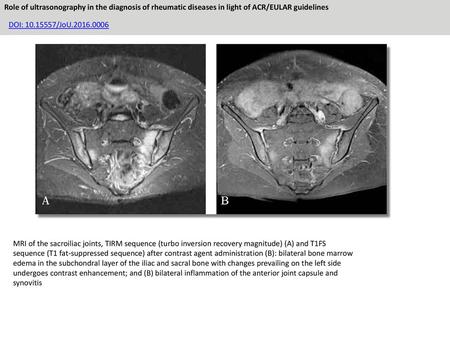 Role of ultrasonography in the diagnosis of rheumatic diseases in light of ACR/EULAR guidelines DOI: 10.15557/JoU.2016.0006 MRI of the sacroiliac joints,