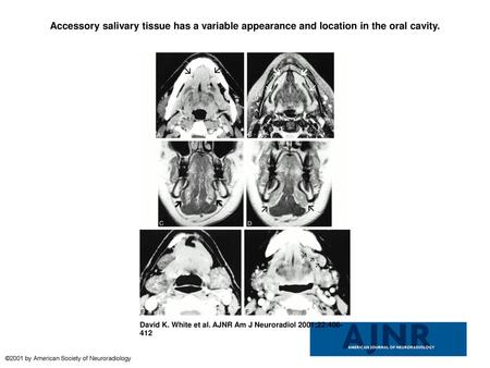 Accessory salivary tissue has a variable appearance and location in the oral cavity. Accessory salivary tissue has a variable appearance and location in.