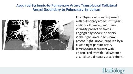 Acquired Systemic-to-Pulmonary Artery Transpleural Collateral Vessel Secondary to Pulmonary Embolism In a 63-year-old man diagnosed with pulmonary embolism.