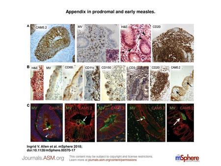 Appendix in prodromal and early measles.